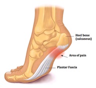 plantarfasciitis